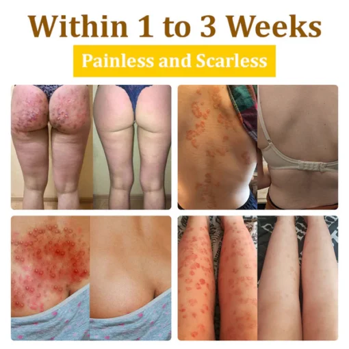 LOVILDS™ 20% Salicylic Acid Skin Treatment Cream