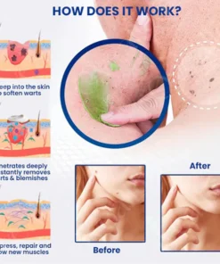 Oveallgo™ EXTRA NatureErase Instant Mole & Spot Cream