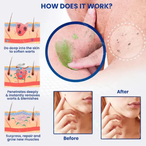 Oveallgo™ EXTRA NatureErase Instant Mole & Spot Cream