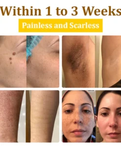 LOVILDS™ 20% Salicylic Acid Skin Treatment Cream