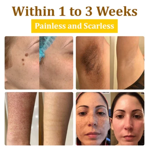 LOVILDS™ 20% Salicylic Acid Skin Treatment Cream