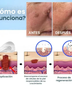 Cvreoz® Nano-Micro Needle Skin Tags Removal Patches
