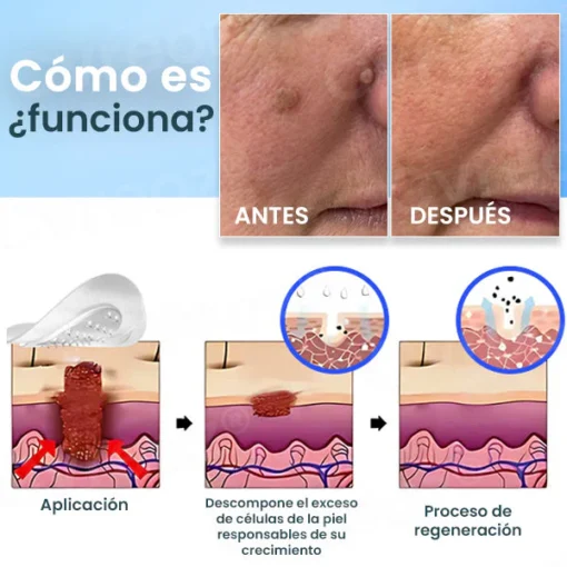 Cvreoz® Nano-Micro Needle Skin Tags Removal Patches