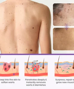 Oveallgo® Clarivine Dissolver Mole & Dark Spot Removal Bio-Gel
