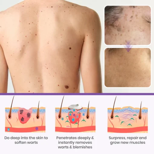Oveallgo® Clarivine Dissolver Mole & Dark Spot Removal Bio-Gel