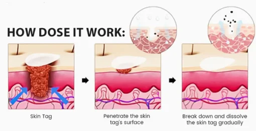 Oveallgo® Magnesium MicroPin Target & Clear Wart Removal Patch