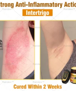 Oxford University Hospital Dermatology Recommendations