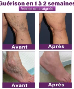 GFOUK® Nano Patch for Varicose Veins with Polidocanol