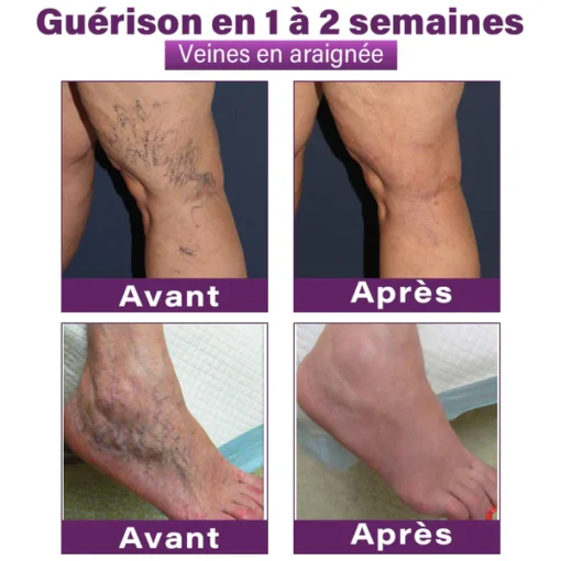 GFOUK® Nano Patch for Varicose Veins with Polidocanol