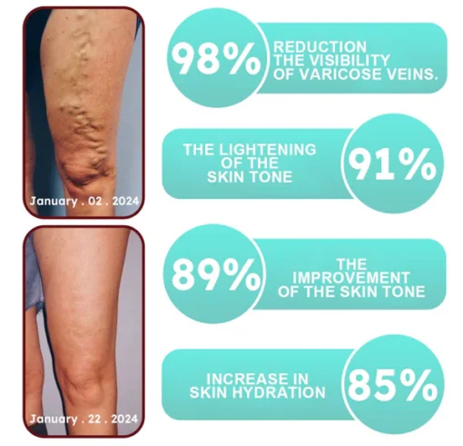 LOVILDS™Leech Varicose Veins Patch
