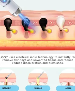 LAOZIK® Non-Invasive Mole and Wart Removal Laser Pen