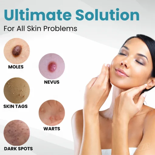 LAOZIK® Non-Invasive Mole and Wart Removal Laser Pen