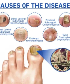 PureNail Fungus Laser Therapy Device