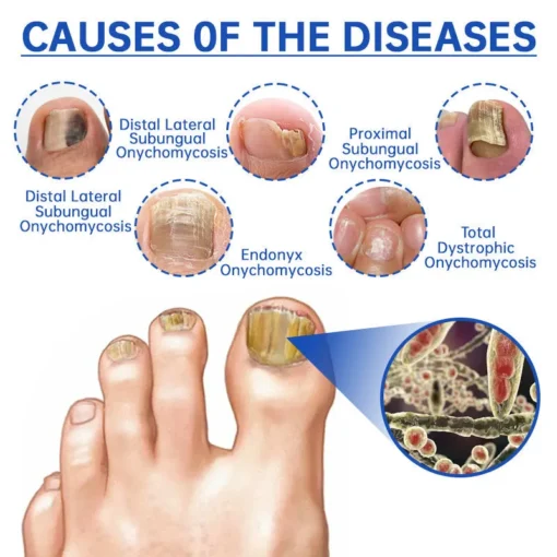 PureNail Fungus Laser Therapy Device