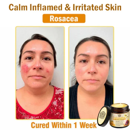 LOVILDS™ Bee Essence Skin Antibacterial Cream