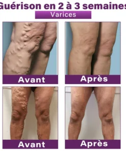 GFOUK® Nano Patch for Varicose Veins with Polidocanol