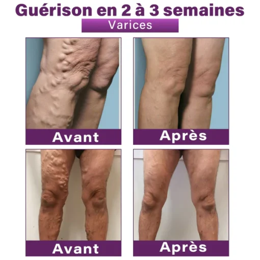GFOUK® Nano Patch for Varicose Veins with Polidocanol