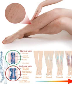 Furzero™ Turmeric Varicose Vein Patch