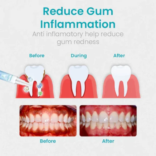 NESLEMY™ Gum Therapy Gel