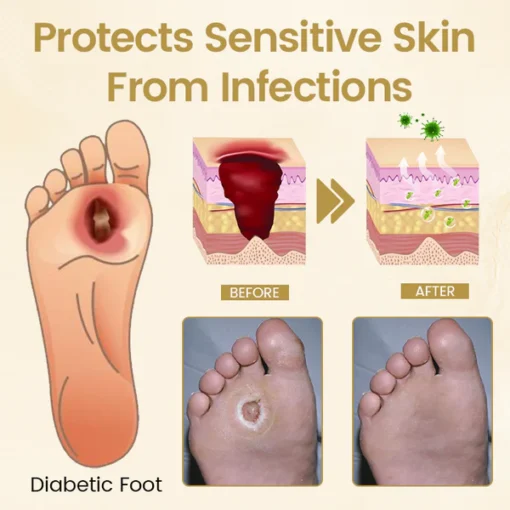Timilk® Diabetic Foot Healing Spray - Bee Venom Infused
