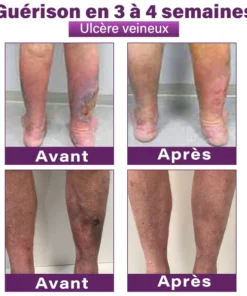 GFOUK® Nano Patch for Varicose Veins with Polidocanol