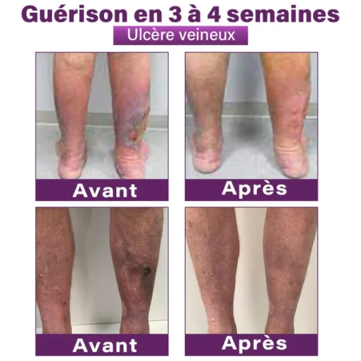 GFOUK® Nano Patch for Varicose Veins with Polidocanol