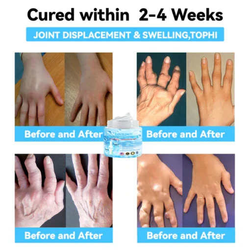 LOVILDS™ 7 Day Rapid Joint & Bone Therapy Cream USA Orthopaedics (AAOS) Approved