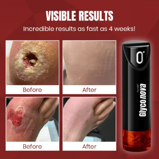 Lyyeto® Glyconova Blood Sugar Inhaler_Ultra01