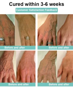 LOVILDS™Leech Varicose Veins Patch