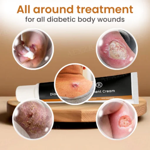 Cvreoz® Diabetic Wounds - ✅ 𝕤𝕒𝕧𝕖 𝕦𝕡 𝕥𝕠 𝟟𝟘% - Treatment Cream