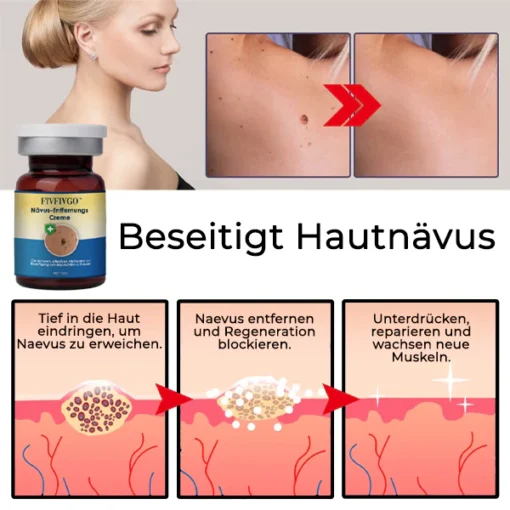 Fivfivgo® Nevus Removal Cream