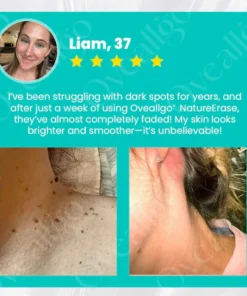 Oveallgo® NatureErase Gel zur sofortigen Entfernung von Muttermalen und Flecken