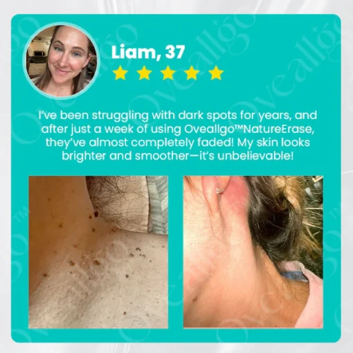 Oveallgo™ Ultra NatureErase Instant Mole & Spot Removal Gel