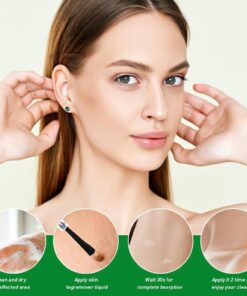 Herbal Acne Treatment Serum