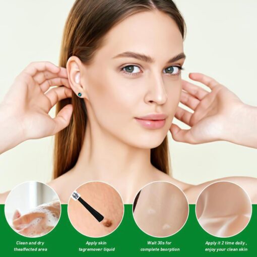 Herbal Acne Treatment Serum