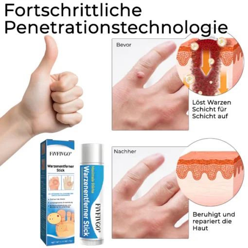Fivfivgo® Wart Remover Stick