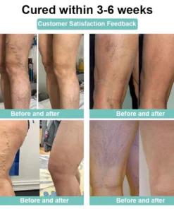 LOVILDS™Leech Varicose Veins Patch