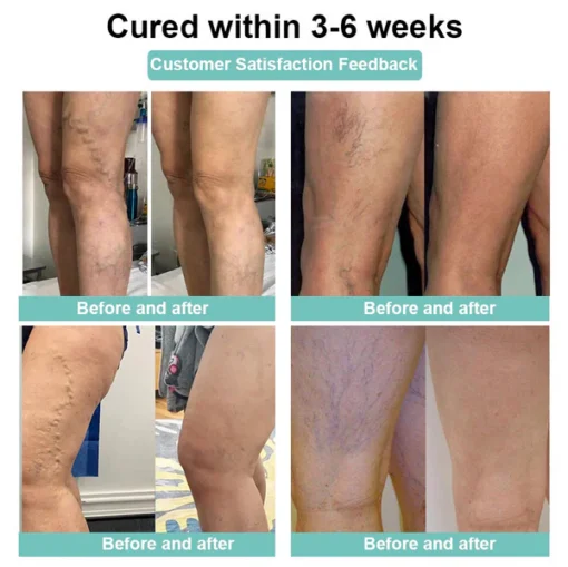 LOVILDS™Leech Varicose Veins Patch