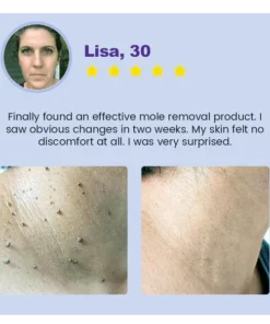 Oveallgo® Clarivine Dissolver Mole & Dark Spot Removal Bio-Gel