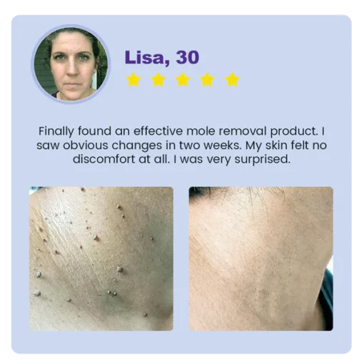 Oveallgo® Clarivine Dissolver Mole & Dark Spot Removal Bio-Gel