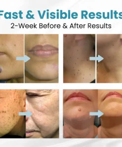 LAOZIK® Non-Invasive Mole and Wart Removal Laser Pen