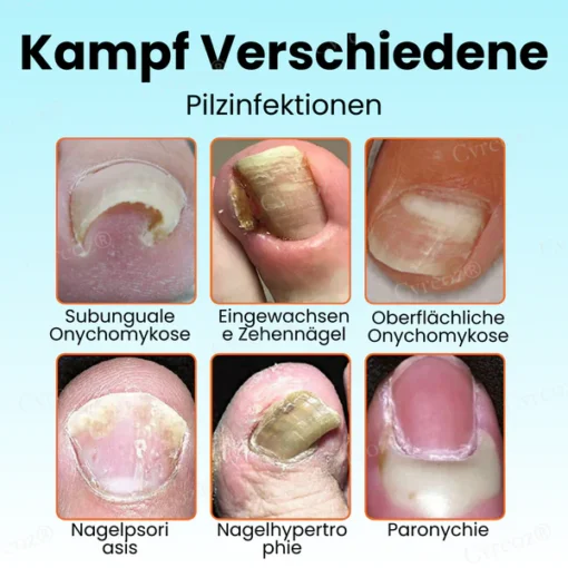 Cvreoz® Nail Strengthening Ointment