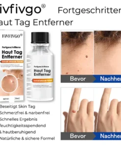 Fivfivgo® Advanced Skin Tag Remover - Fast Acting Formula