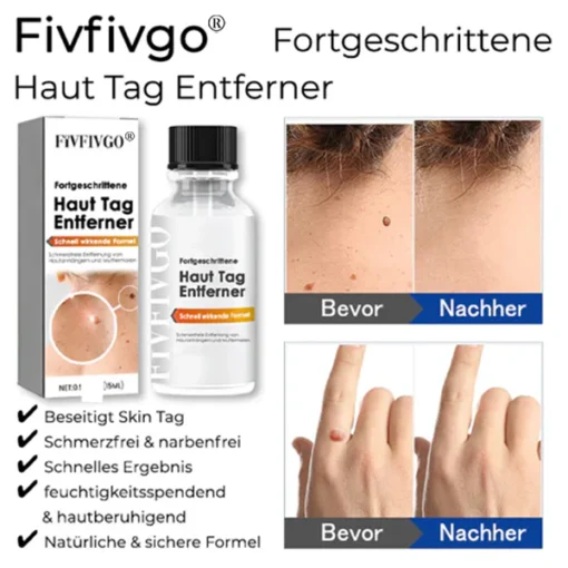 Fivfivgo® Advanced Skin Tag Remover - Fast Acting Formula