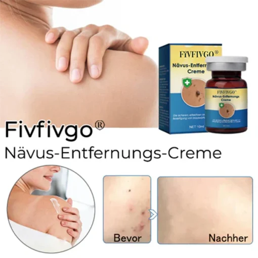 Fivfivgo® Nevus Removal Cream