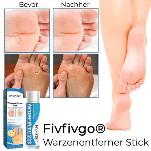 Fivfivgo® Wart Remover Stick