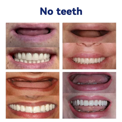 NESLEMY™-🦷Advanced Customized Full Denture Set
