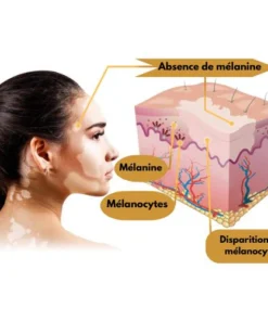Vitiligo Treatment Cream