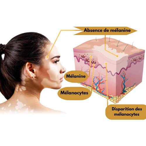 Vitiligo Treatment Cream