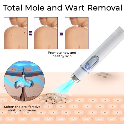 Bikenda® Mole and Wart Removal Laser Set